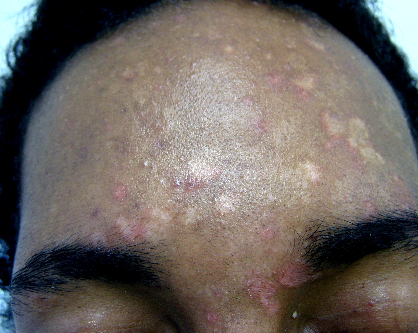 Pityriasis versicolor frontal retouche